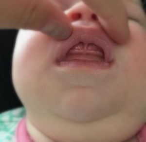 Fixing My Baby's Lip Tie Fixed My Breastfeeding Frustration from Albuquerque Moms Blog