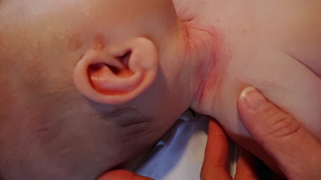 eczema flare