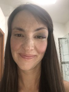 Ashley after a mountain bike accident 